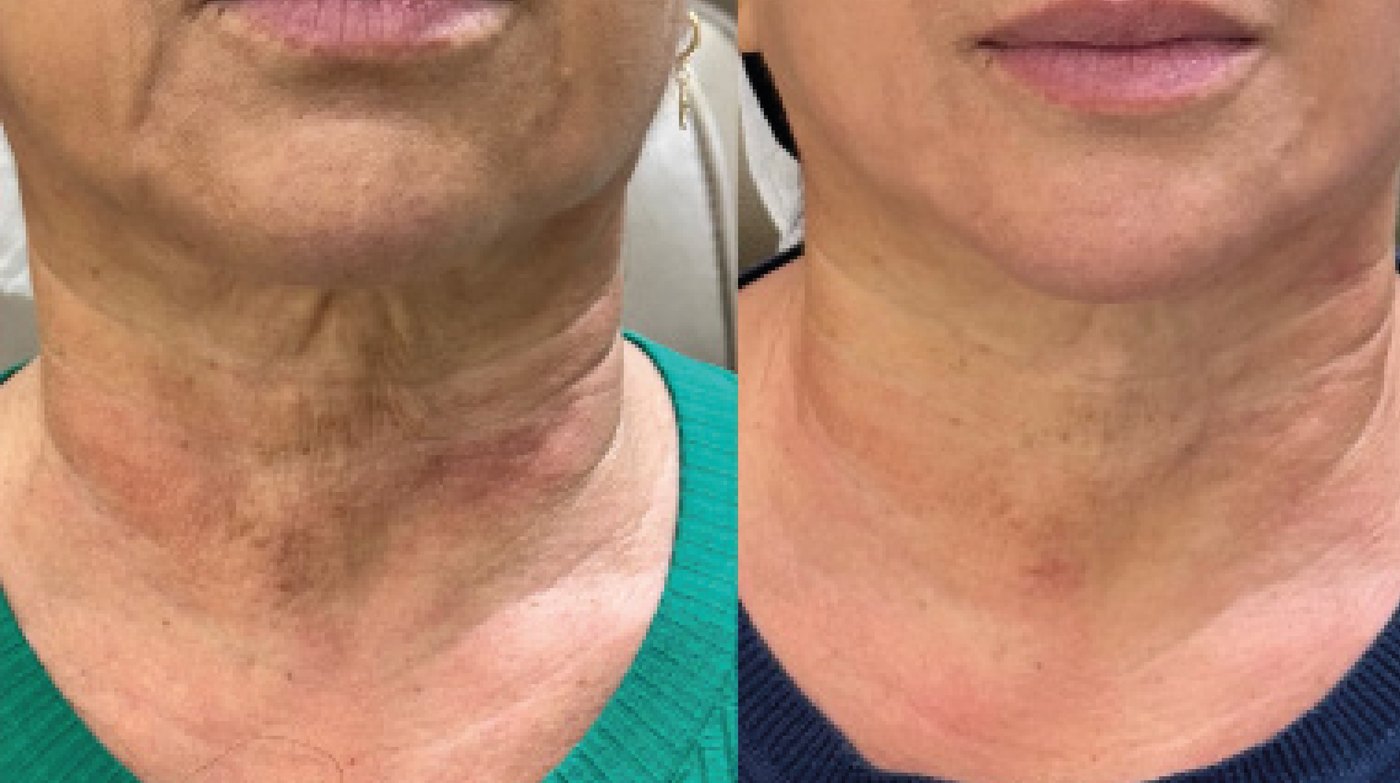 Antes e depois do tratamento de pescoço com Zaffiro