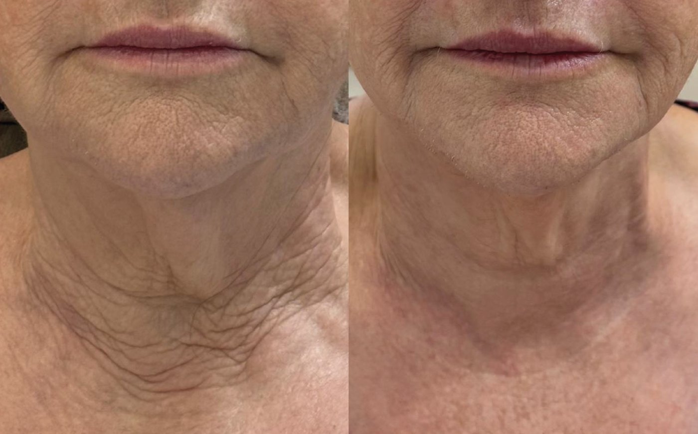 Antes e depois do tratamento de pescoço com Zaffiro
